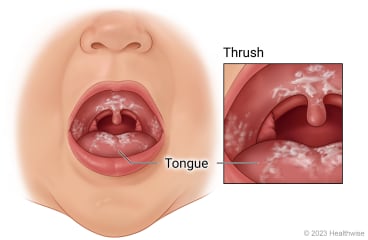 Thrush in child's mouth, with close-up of thrush on tongue and roof of mouth.