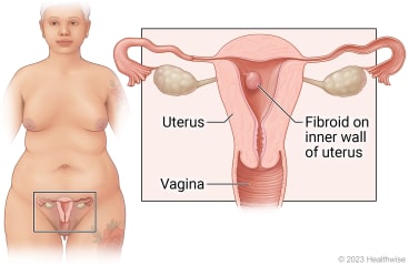 Female reproductive organs in pelvis, including uterus and vagina, with detail showing fibroid growing on inner wall of uterus.