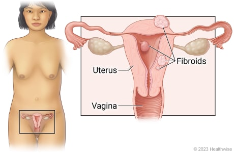 Female reproductive organs in pelvis, including uterus and vagina, with detail showing fibroids growing on outer and inner wall of uterus, and inside wall of uterus.