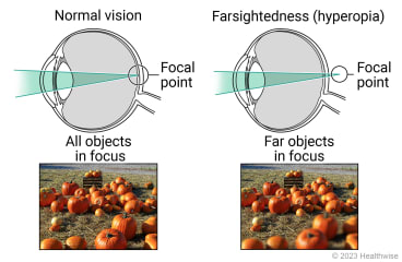 Normal vision, with focal point at retina with all objects in focus, compared to farsightedness, with focal point behind retina and far objects in focus.