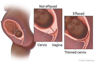 Head of fetus down near cervix before birth, with detail of cervix not effaced and detail of effaced or thinned cervix as delivery nears.