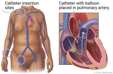 Body showing heart and catheter insertion sites at neck, groin and wrist, with detail of catheter placed in pulmonary artery with inflated balloon at end.