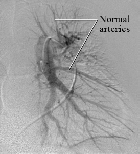 Angiogram image of the lung