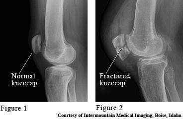 Normal and broken kneecaps