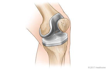 Illustration of knee replacement components