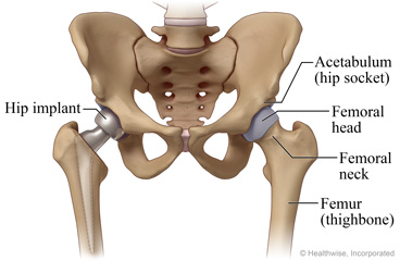 Normal hip and partial hip replacement