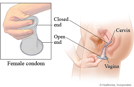 Female condom inserted into the vagina