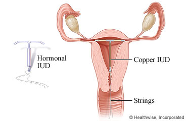 An IUD in the uterus