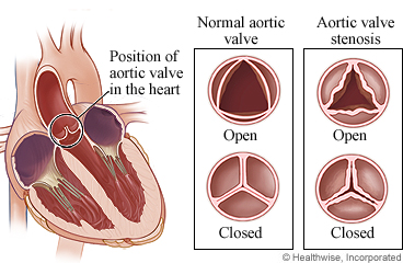 Normal aortic valve and a valve with stenosis
