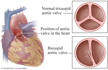 Location of aortic valve in heart, with details of a tricuspid valve and a bicuspid valve