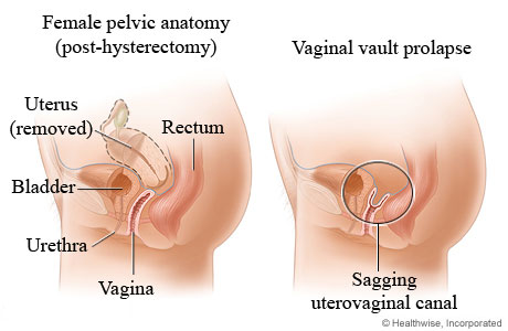 Female pelvic anatomy after hysterectomy showing uterus removed, and anatomy with vaginal vault prolapse showing sagging uterovaginal canal.