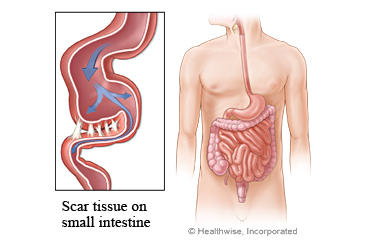 Adhesions on the small intestine