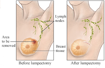 Before and after a lumpectomy