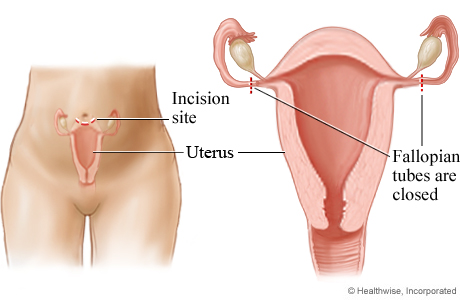 Picture of postpartum tubal ligation