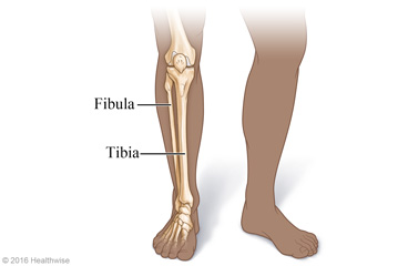 Lower leg fracture