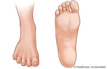 Picture of top and bottom of foot