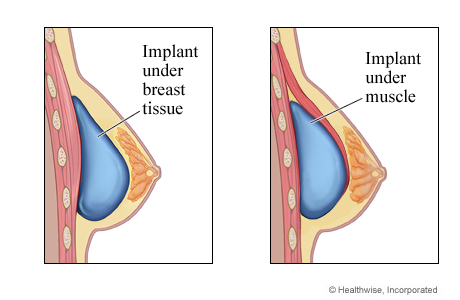 What is the smallest breast implant they make❓How do you know