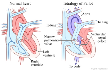 Normal heart and heart showing the four problems of tetralogy of Fallot and change in blood flow