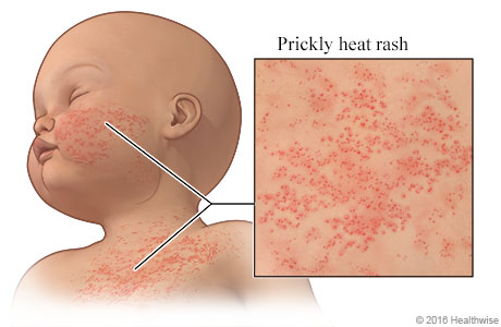 Heat rash on a baby's chest and cheek, with close-up of the rash
