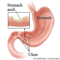 Peptic ulcers in the stomach