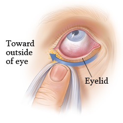 Picture of how to correctly wipe an eye infected with pinkeye