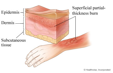 Cross section of skin on lower arm, with burn in epidermis and top part of dermis layers.