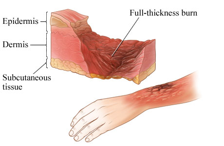 Cross section of skin on lower arm, with burn through all layers of skin.