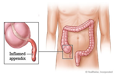 Appendicitis and location of appendix