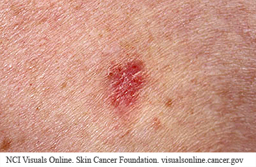Basal skin cancer