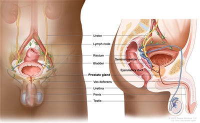 Drawing of the male reproductive system and urinary system anatomy showing the front and side views of the ureters, bladder, prostate gland, vas deferens, urethra, penis, and testicles. A side view of the seminal vesicle and ejaculatory duct is also shown. The drawing also shows front and side views of the rectum and lymph nodes in the pelvis.