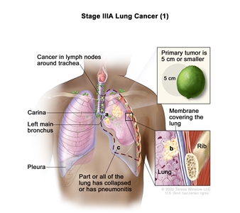 Stage IIIA lung cancer (1); drawing shows a primary tumor (5 cm or smaller) in the left lung (top inset) and cancer in lymph nodes around the trachea. Also shown is cancer that has spread to (a) the left main bronchus and (b) the membrane covering the lung (bottom inset). Also shown is (c) part or all of the lung has collapsed or has pneumonitis (inflammation). The carina, pleura, and a rib (bottom inset) are also shown.