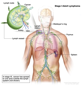Stage I adult lymphoma; drawing shows cancer in one lymph node group and in the spleen. Also shown are the Waldeyer's ring and the thymus. An inset shows a lymph node with a lymph vessel, an artery, and a vein. Cancer cells are shown in the lymph node.