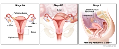 Three-panel drawing of stage IIA, stage IIB, and stage II primary peritoneal cancer; the first panel (stage IIA) shows cancer inside both ovaries that has spread to the fallopian tube and uterus . Also shown are the cervix and vagina. The second panel (stage IIB) shows cancer inside both ovaries that has spread to the colon. The third panel (primary peritoneal cancer) shows cancer in the pelvic peritoneum.
