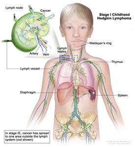 Stage I childhood Hodgkin lymphoma; drawing shows cancer in one lymph node group above the diaphragm and in the spleen. Also shown are the Waldeyer's ring and the thymus. An inset shows a lymph node with a lymph vessel, an artery, and a vein. Cancer cells are shown inside the lymph node.
