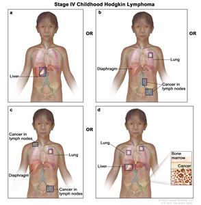 Stage IV childhood Hodgkin lymphoma; drawing shows four panels: (a) the top left panel shows cancer in the liver; (b) the top right panel shows cancer in the left lung and in two groups of lymph nodes below the diaphragm; (c) the bottom left panel shows cancer in the left lung and in a group of lymph nodes above the diaphragm and below the diaphragm; and (d) the bottom right panel shows cancer in both lungs and the liver. There is also a pullout showing cancer in the bone marrow.