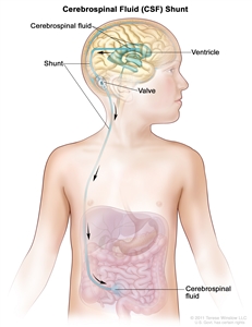 Cerebrospinal fluid (CSF) diversion; drawing shows extra CSF flowing through a tube (shunt) from a ventricle in the brain into the abdomen. The shunt goes from the ventricle, under the skin in the neck and chest, and into the abdomen. Also shown is a valve that controls the flow of CSF.