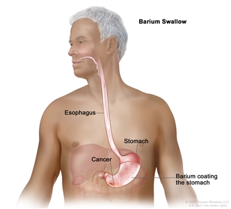 Barium swallow; drawing shows barium liquid flowing down the esophagus and into the stomach. The barium coats and outlines the inside of the esophagus and stomach. Also shown is cancer in the stomach.