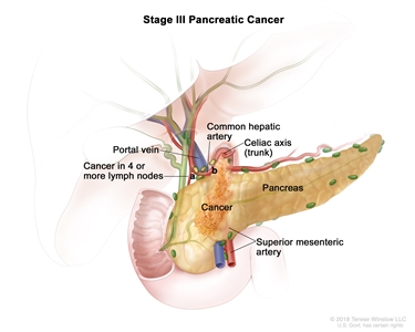 Stage III pancreatic cancer; drawing shows cancer in the pancreas and in (a) 4 or more nearby lymph nodes and (b) the common hepatic artery. Also shown are the portal vein, celiac axis (trunk), and superior mesenteric artery.