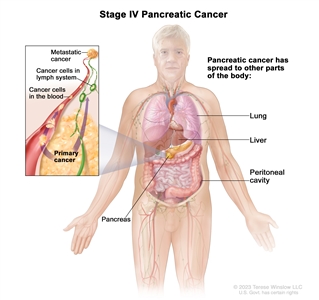 Stage IV pancreatic cancer; drawing shows other parts of the body where pancreatic cancer may spread, including the lung, liver, and peritoneal cavity. An inset shows cancer cells spreading from the pancreas, through the blood and lymph system, to another part of the body where metastatic cancer has formed.