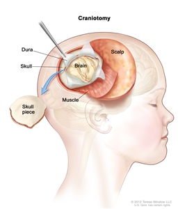 Drawing of a craniotomy showing a section of the scalp that has been pulled back to remove a piece of the skull; the dura covering the brain has been opened to expose the brain. The layer of muscle under the scalp is also shown.