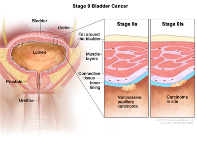 Stage 0 bladder cancer (noninvasive bladder cancer); drawing shows the bladder, lumen (the space where urine collects), ureter, prostate, and urethra. The first inset shows stage 0a (also called noninvasive papillary carcinoma) on the inner lining of the bladder. The second inset shows stage 0is (also called carcinoma in situ) on the inner lining of the bladder. Also shown are the connective tissue and muscle layers of the bladder and the layer of fat around the bladder.