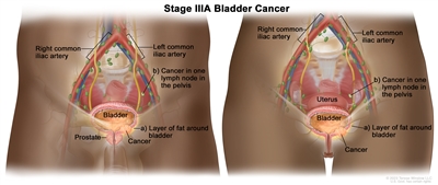 Stage IIIA bladder cancer; drawing shows cancer in the bladder and in (a) the layer of fat around the bladder and (b) one lymph node in the pelvis. Also shown are the right and left common iliac arteries and the prostate.