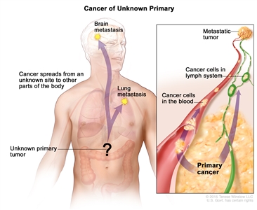 Carcinoma of unknown primary; drawing shows a primary tumor that has spread from an unknown site to other parts of the body (the lung and the brain). An inset shows cancer cells spreading from the primary cancer, through the blood and lymph systems, to another part of the body where a metastatic tumor has formed.