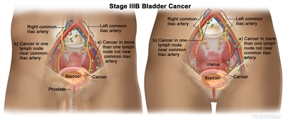 Stage IIIB bladder cancer; drawing shows cancer in the bladder and in (a) more than one lymph node in the pelvis that is not near the common iliac artery and (b) one lymph node near the common iliac artery. Also shown are the right and left common iliac arteries.