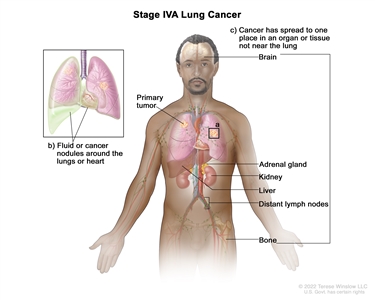Stage IVA lung cancer; drawing shows a primary tumor in the right lung and (a) a tumor in the left lung. Also shown is (b) fluid or cancer nodules around the lungs or heart (inset), and (c) other organs or tissues where lung cancer may spread, including the brain, adrenal gland, kidney, liver, bone, and distant lymph nodes.