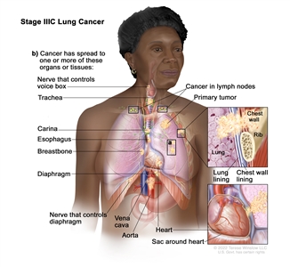 Stage IIIC lung cancer; drawing shows a primary tumor in the left lung and (a) separate tumors in the same lobe of the lung with the primary tumor. Also shown is cancer in lymph nodes above the collarbone on the same side and opposite side of the chest as the primary tumor. Also shown is (b) cancer that has spread to the following: the chest wall and the lining of the chest wall and lung, the nerve that controls the voice box, the trachea, the carina, the esophagus, the breastbone, the diaphragm, the nerve that controls the diaphragm, the heart, the aorta and vena cava, and the sac around the heart.