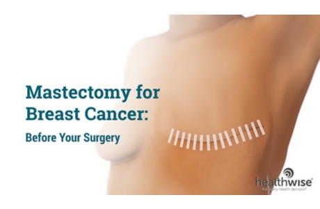 Choosing a Prosthesis After Breast Cancer Surgery
