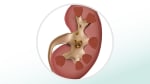 Kidney stones: Fast Facts