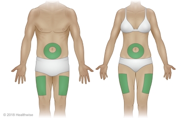 Puntos de inyección en el abdomen y la parte externa del muslo en hombres y mujeres