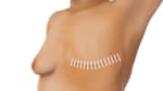 EL brasier de Mastectomia, No solo es para personas que han sufrido un  proceso de extración de mama, este bra permite descansar el busto